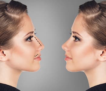 Istanbul Plastic Surgery Support - ( Vaser Liposuction, Nose Job, Tummy Tuck, BBL, Facelift, Implants, Laser, Lip Lift, Gynecomastia)