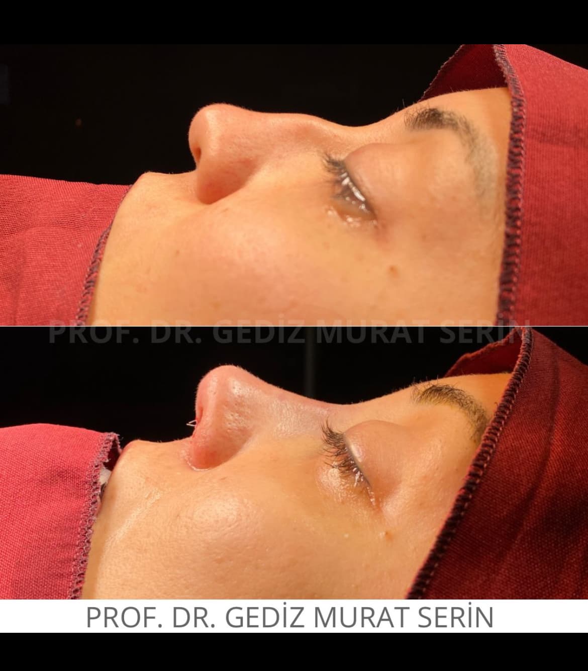 Prof. Dr. Gediz Murat Serin | Kulak Burun Boğaz | Burun Estetiği | Revizyon Burun Estetiği | Septum Perforasyonu | Sinüzit