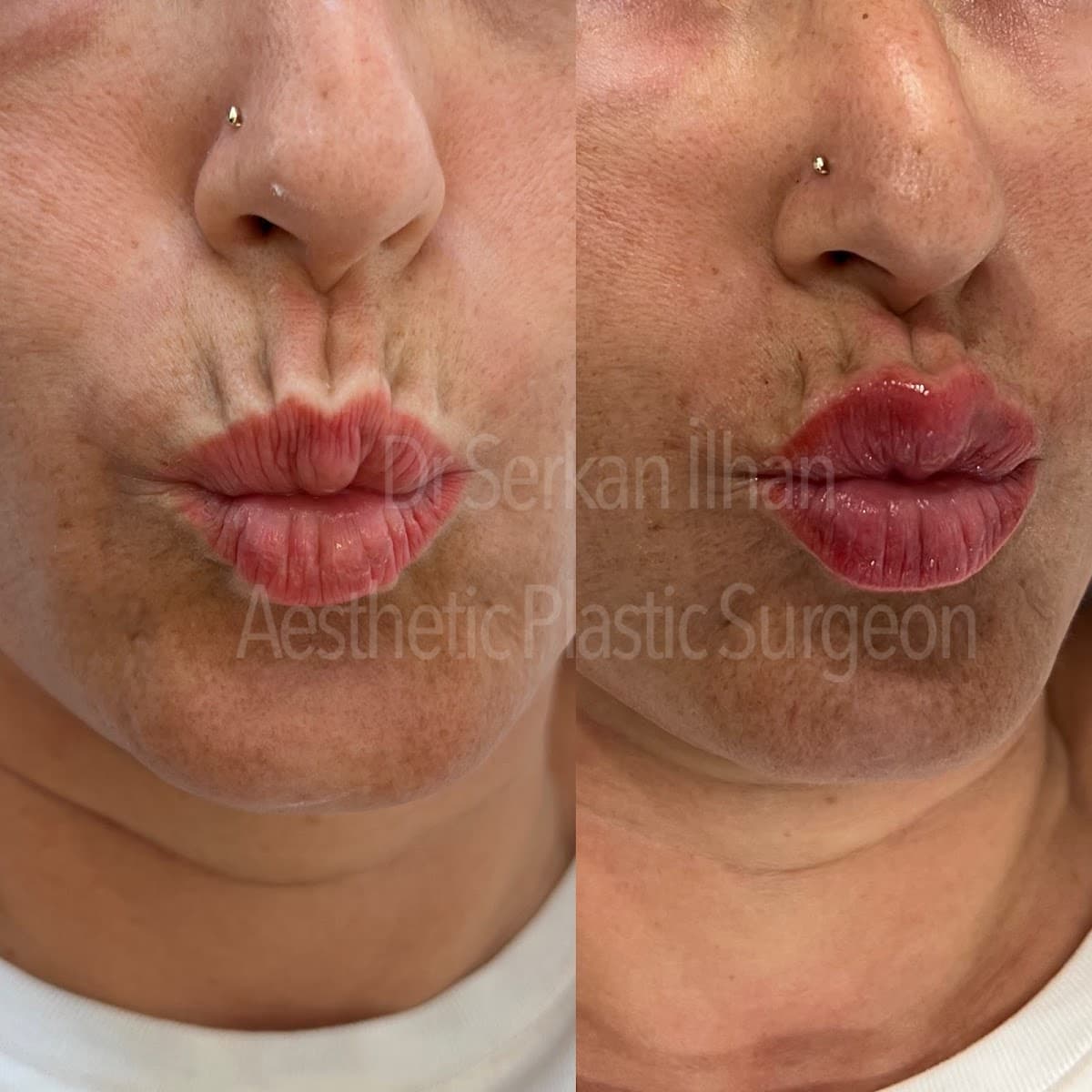 Cosmetic Surgery In Antalya