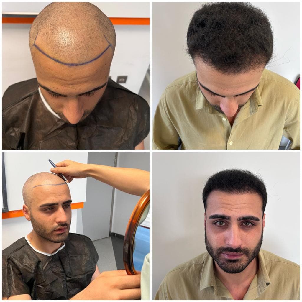 Hair Nirvana | İzmir Saç Ekim Merkezi