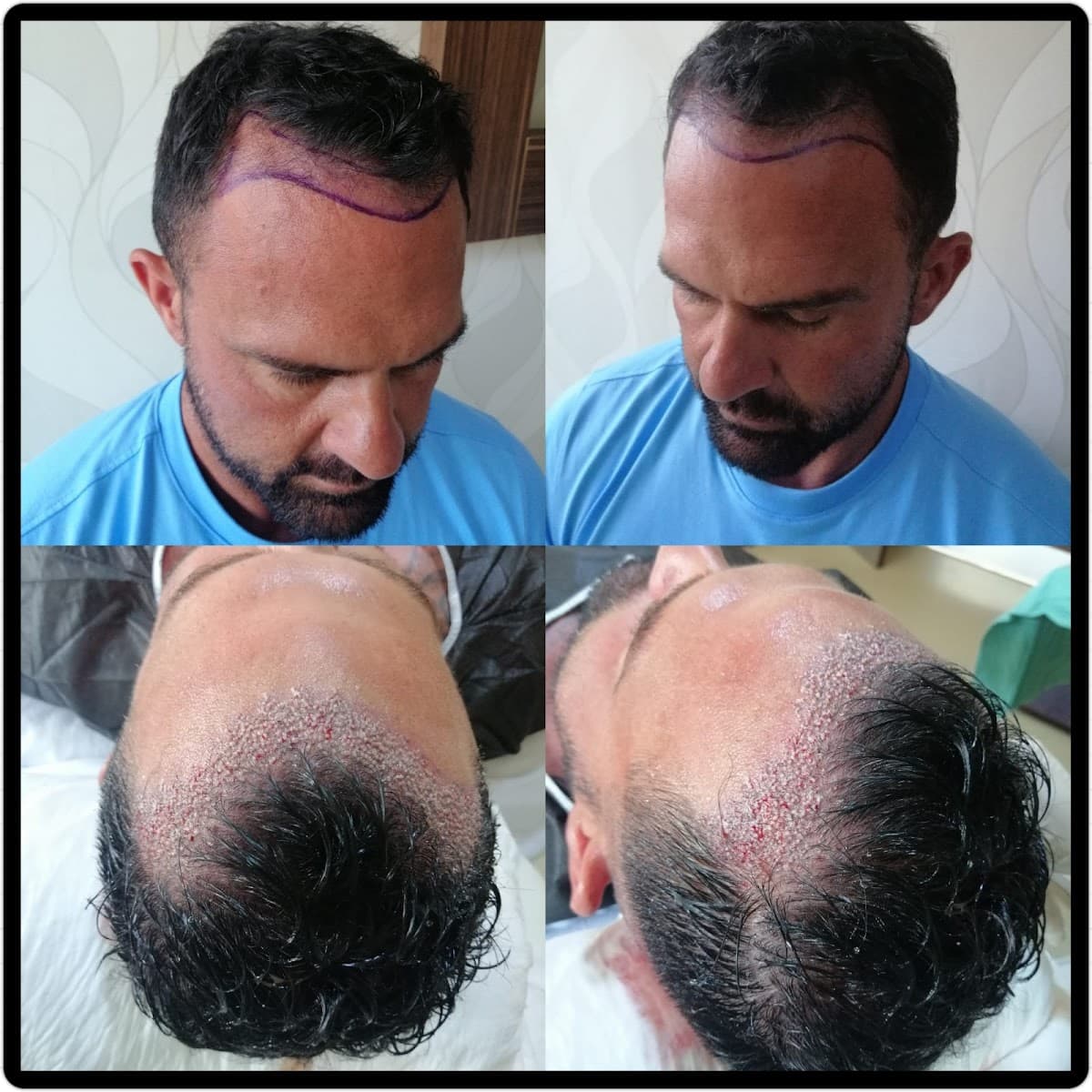 Hair Nirvana | İzmir Saç Ekim Merkezi