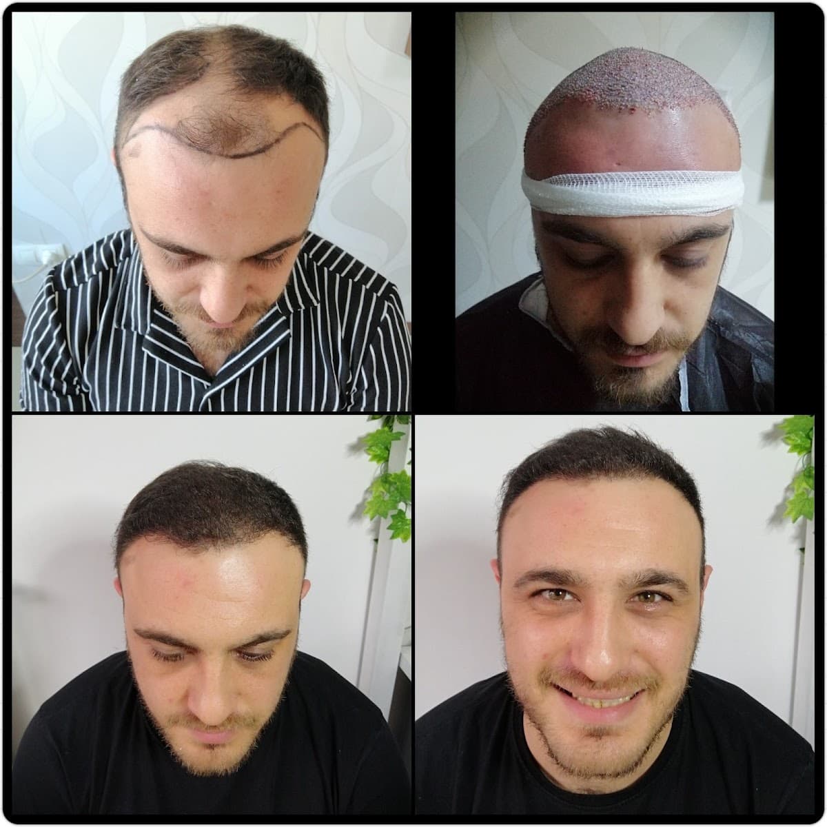 Hair Nirvana | İzmir Saç Ekim Merkezi