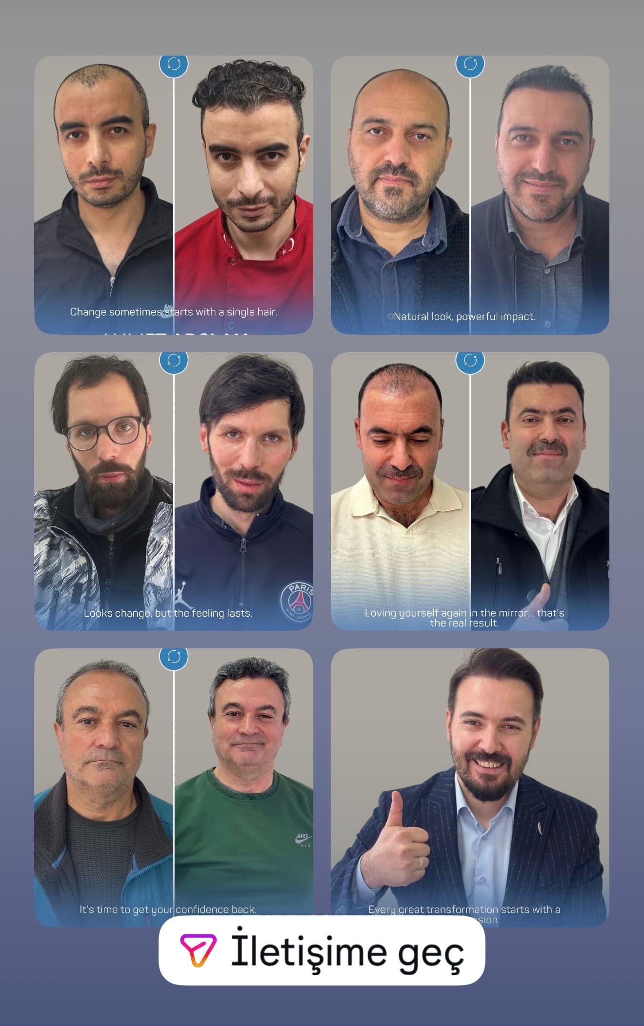 Ahmet Arslan Hair Transplant Ankara Saç Ekimi