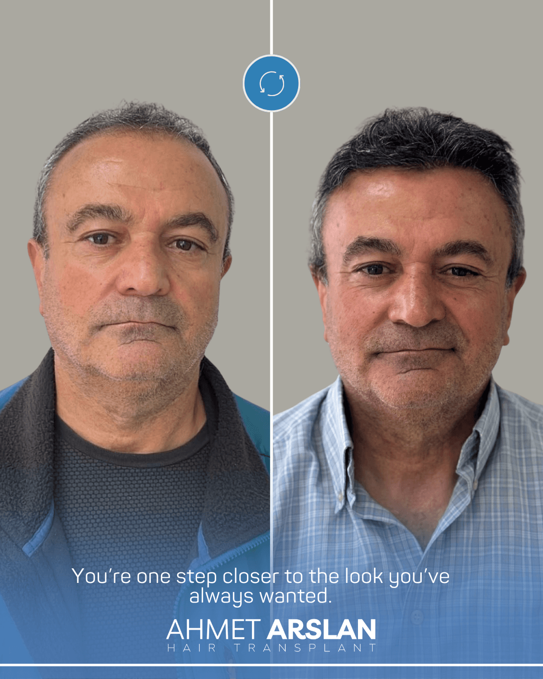 Ahmet Arslan Hair Transplant Ankara Saç Ekimi