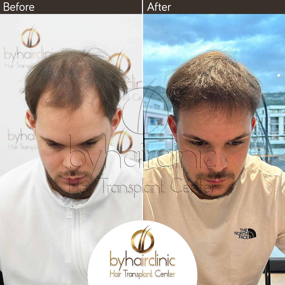 byhairclinic | Hair Transplant Center