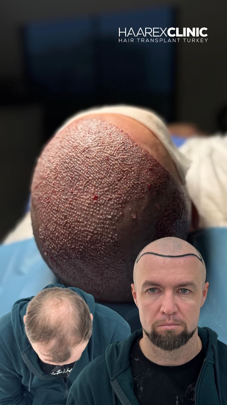 Haarexclinic Hair Transplant Antalya / Antalya Saç Ekimi