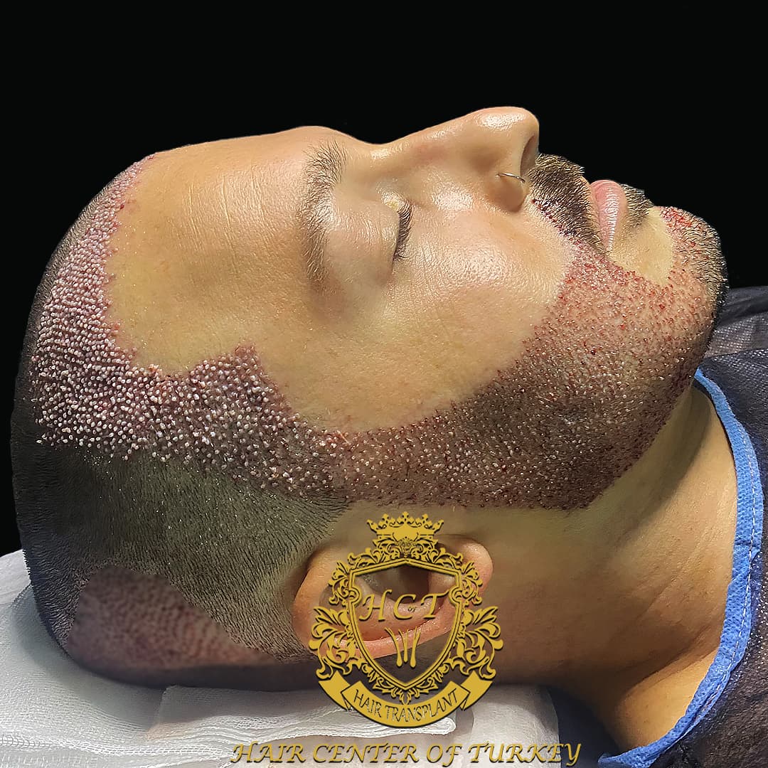 Hair Center Of Turkey