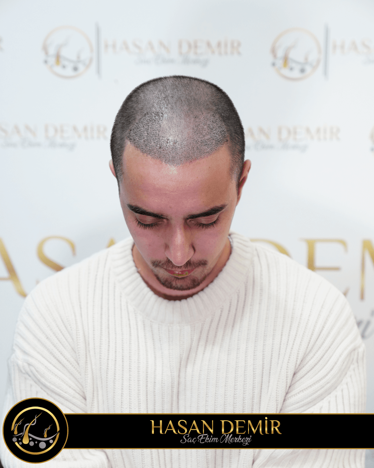 Hasan Demir Saç Ekimi Ankara