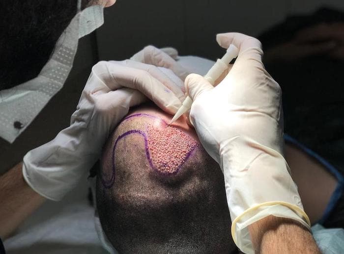 زراعة الشعر في تركيا اسطنبول - INF.Clinic Turkey