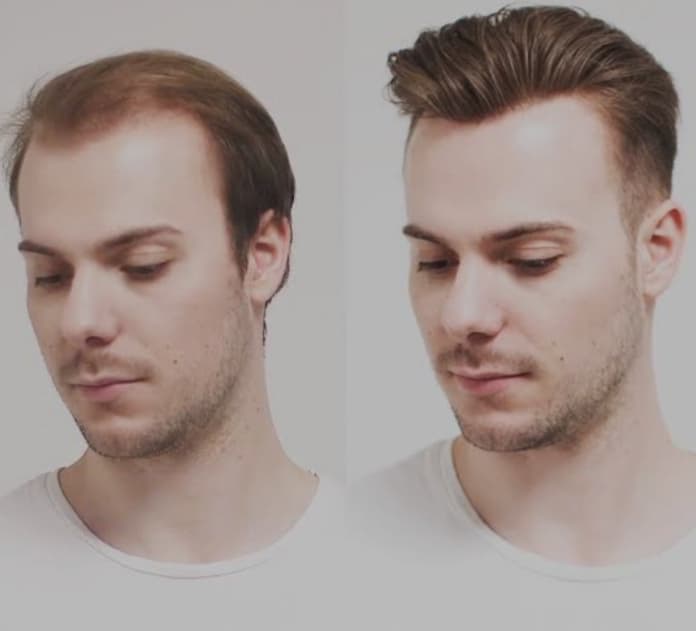 VOONHAİR PROTEZ SAÇ ANKARA